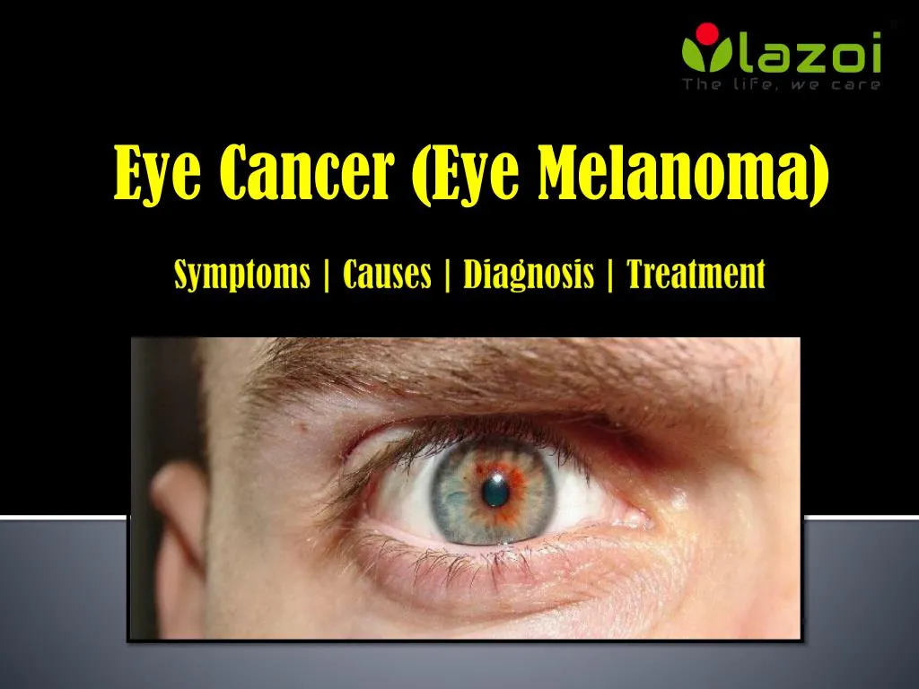 eye cancer eye melanoma