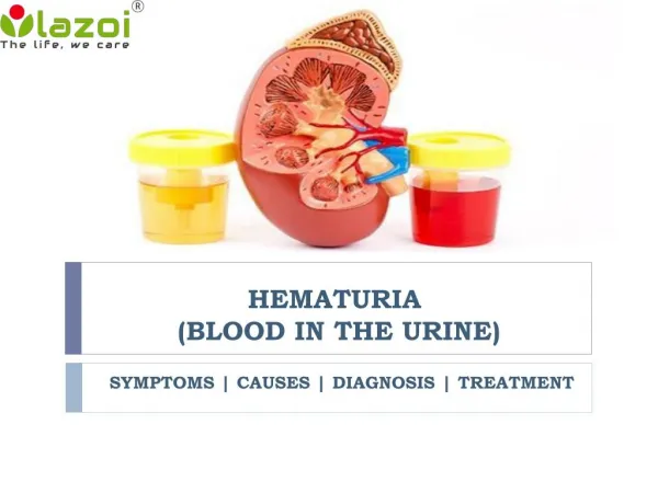 Hematuria (Blood in the urine): Symptoms, causes, diagnosis and treatment