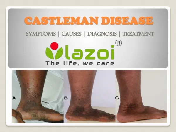 Castleman Disease : Symptoms, causes, diagnosis and treatment