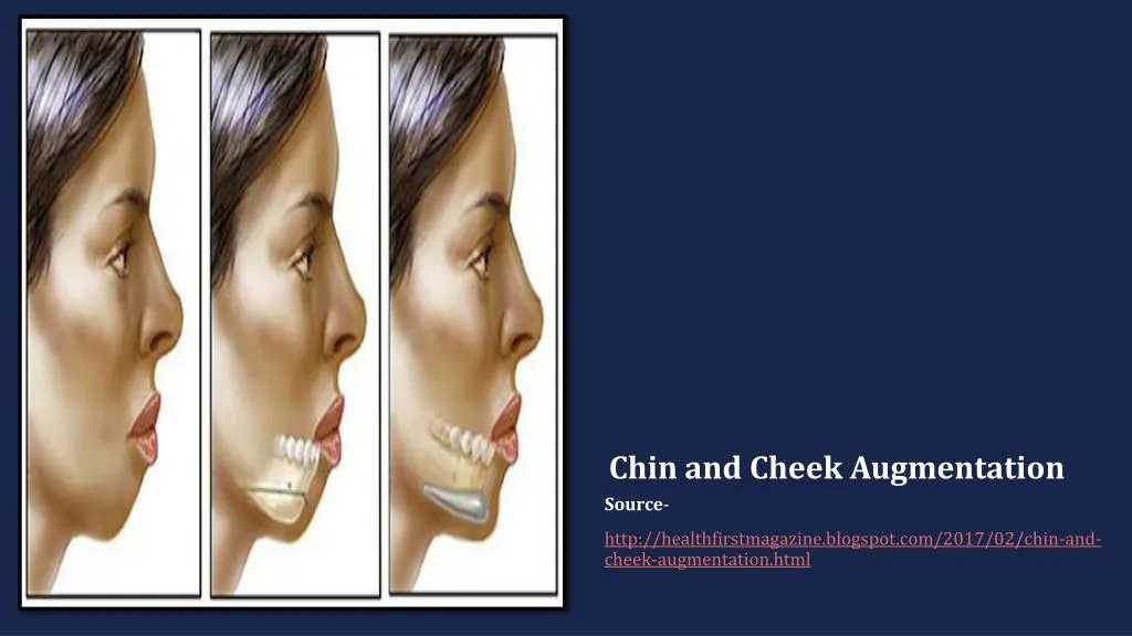 chin and cheek augmentation
