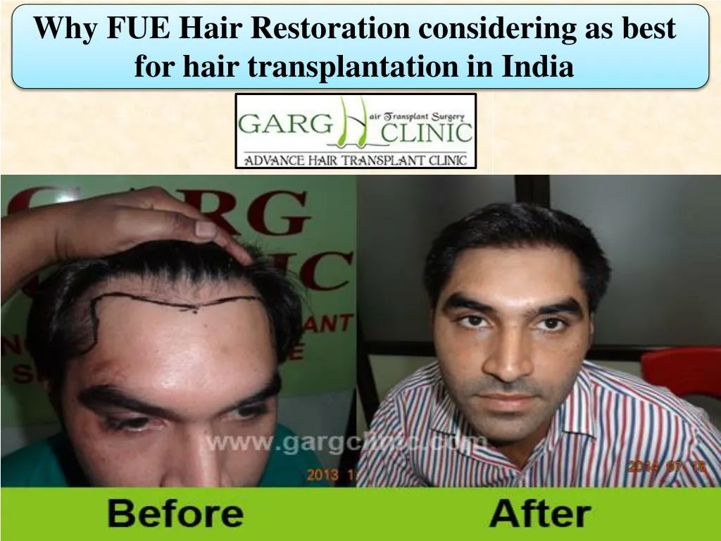 why fue hair restoration considering as best