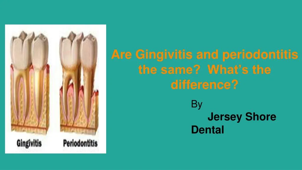 are gingivitis and periodontitis the same what s the difference