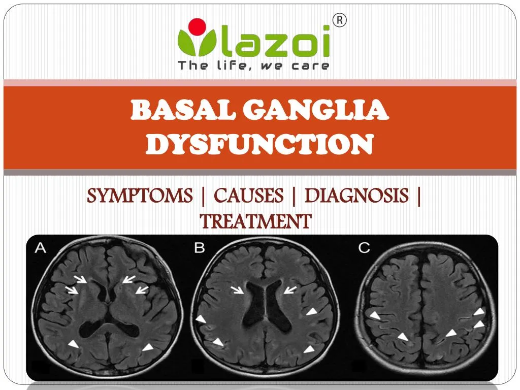 basal ganglia dysfunction