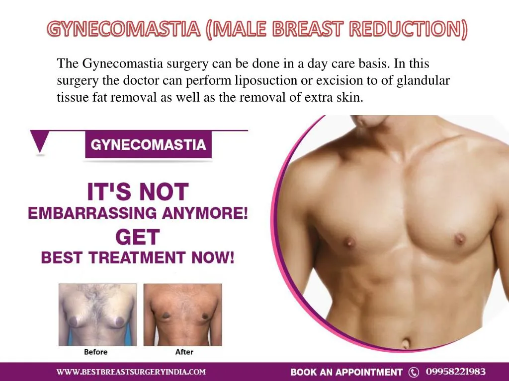 gynecomastia male breast reduction