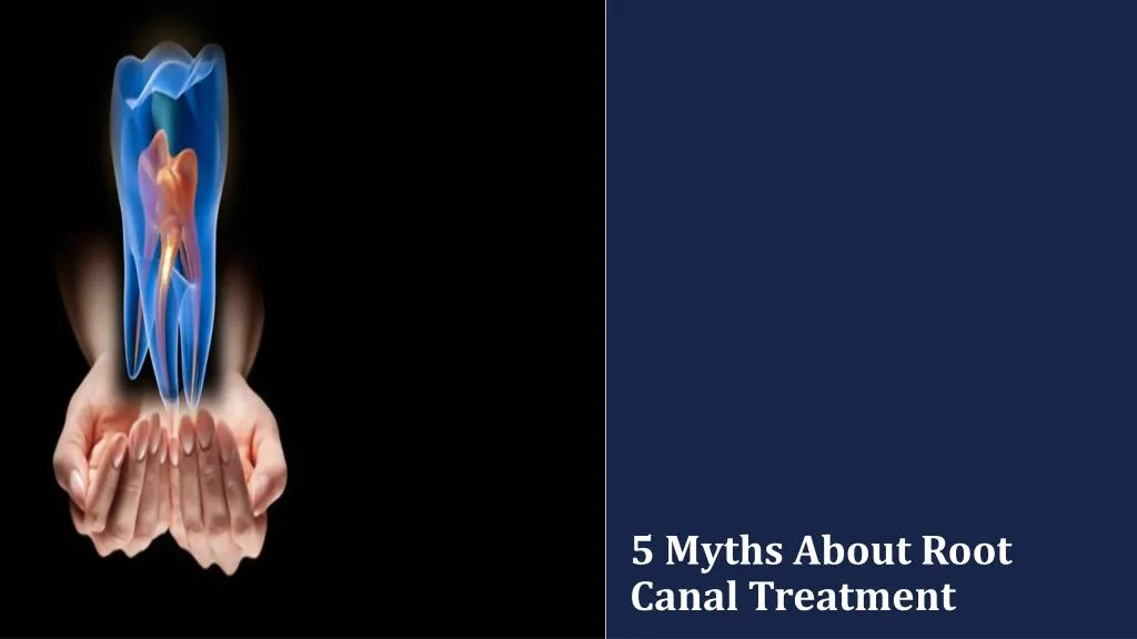 5 myths about root canal treatment