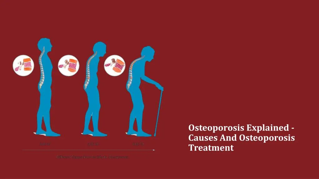 osteoporosis explained causes and osteoporosis treatment