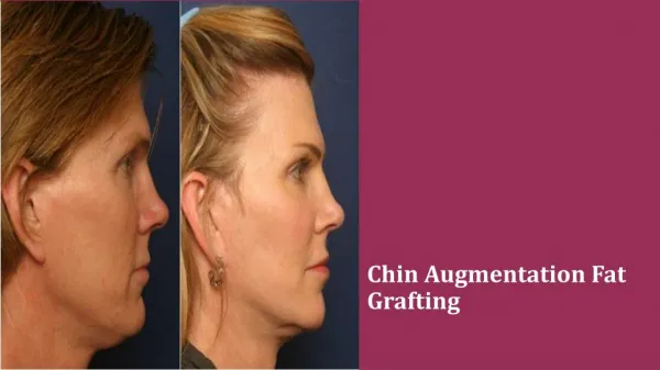 Chin Augmentation Fat Grafting