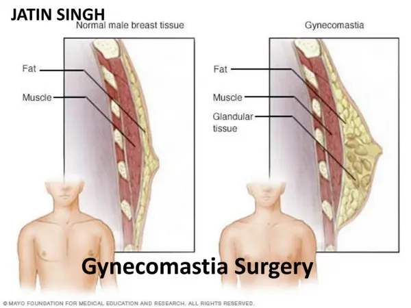 History,Advantages and Disadvantages of Gynecomastia Surgery