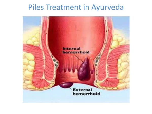 Piles Treatment in Ayurveda