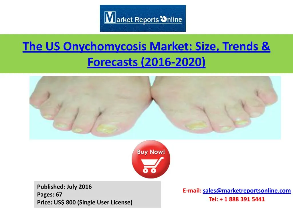 the us onychomycosis market size trends forecasts