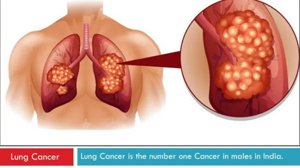 Early Symptoms, Diagnosis and Detection of Lung Cancer - Dr.(Prof.) Arvind Kumar