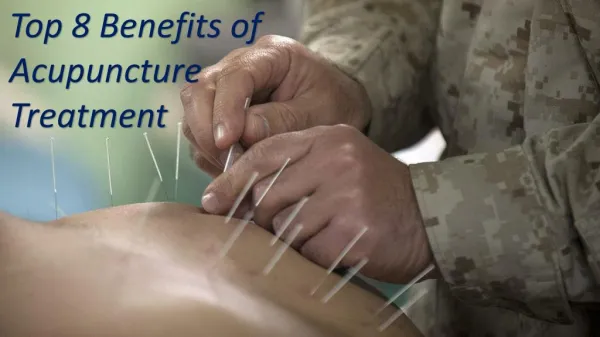 Top 8 benefits of Acupuncture Treatment