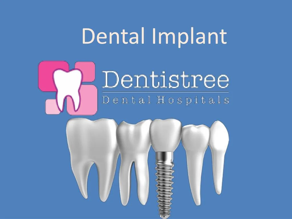 dental implant