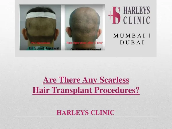Are There Any Scarless Hair Transplant Procedures?