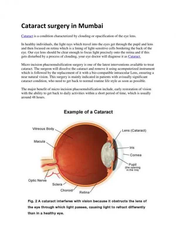 Cataract surgery in Mumbai