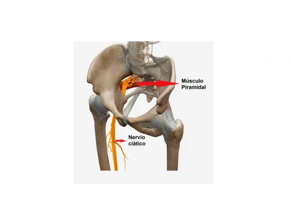 Tratamiento Para El Nervio Ciatico, Hernia De Disco Lumbar, Ciatica Medicamentos, Cuanto Dura La Ciatica