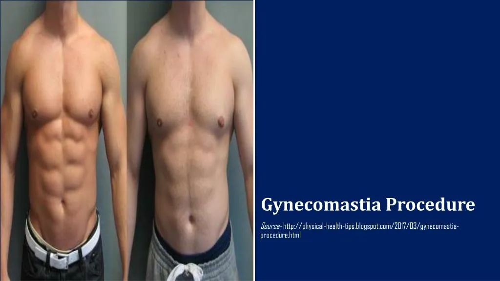 gynecomastia procedure