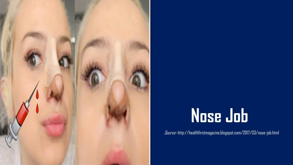 nose job