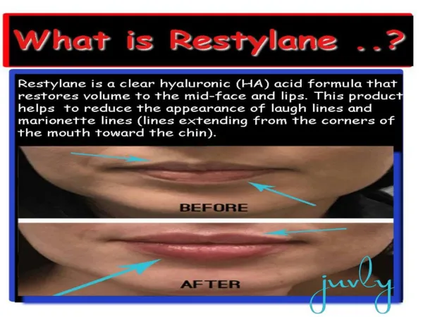 Restylane Treatment For Lip & Face Augmentation