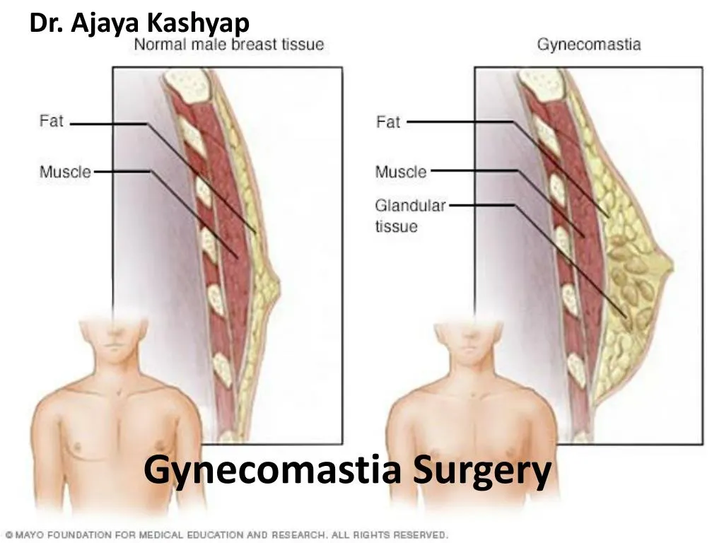 gynecomastia surgery