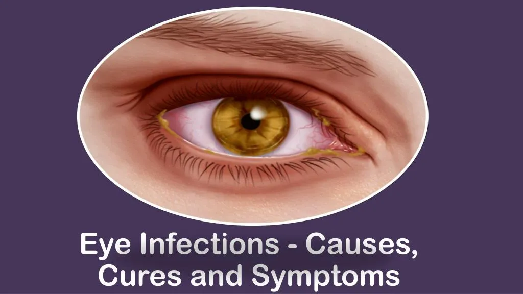 eye infections causes cures and symptoms