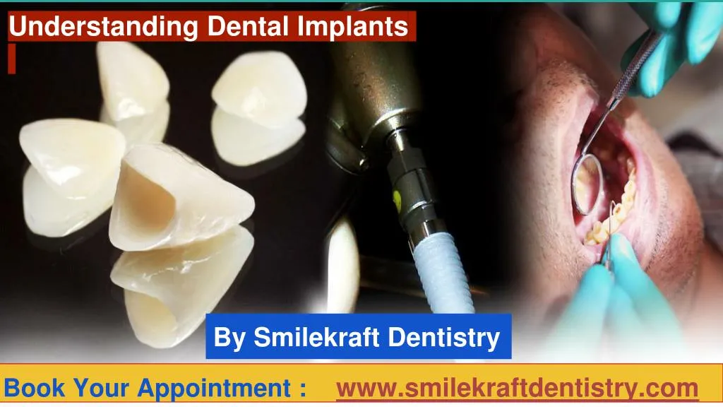 understanding dental implants