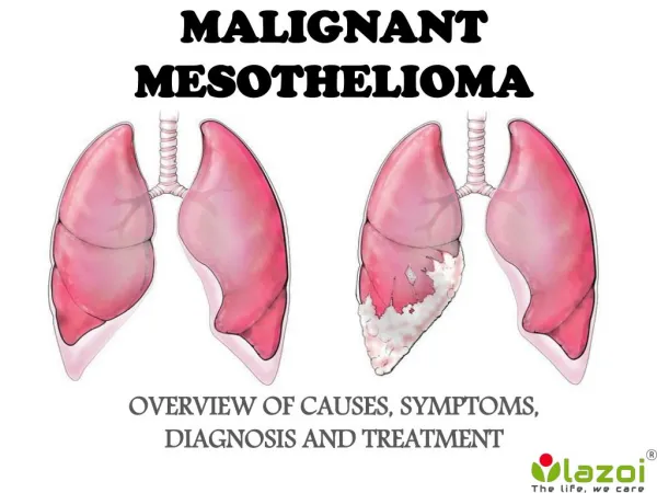 Malignant Mesothelioma: Overview of symptoms, diagnosis and treatment