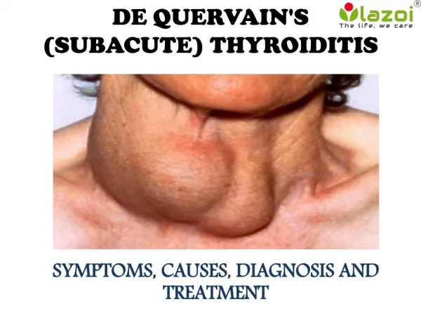 De Quervain's (subacute) thyroiditis: Symptoms, causes, diagnosis and treatment