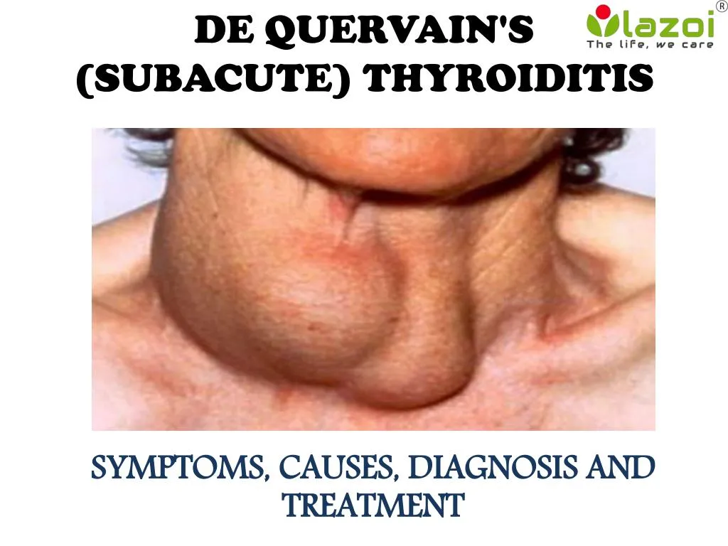de quervain s subacute thyroiditis
