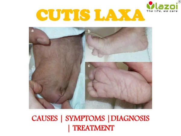 Cutis Laxa : Causes, symptoms, diagnosis, treatment and prevention