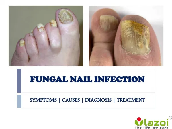 Fungal Nail Infection: causes, symptoms, diagnosis and treatment