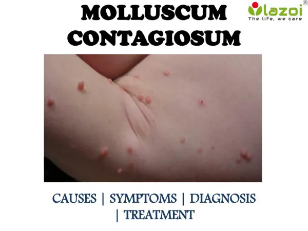 Molluscum Contagiosum : causes, symptoms and treatment