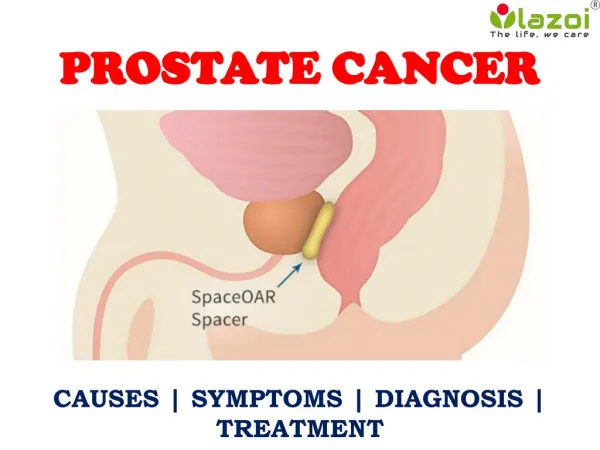 Prostate Cancer: Information on symptoms, treatment and more