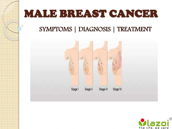 Male Breast Cancer : Symptoms, diagnosis and treatment
