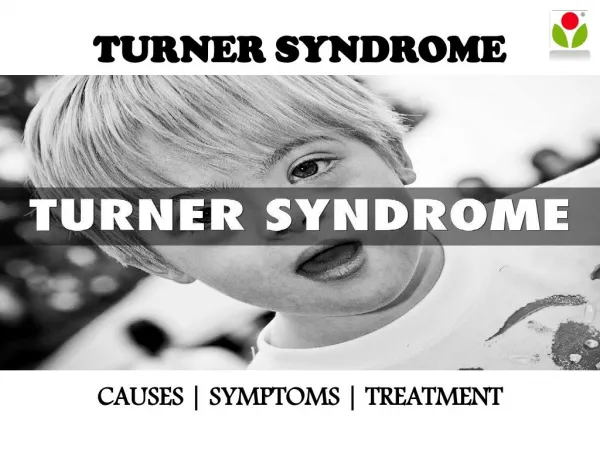 Turner syndrome : causes, symptoms and treatment
