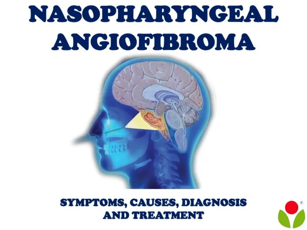 Nasopharyngeal Angiofibroma: Symptoms, causes, diagnosis and treatment