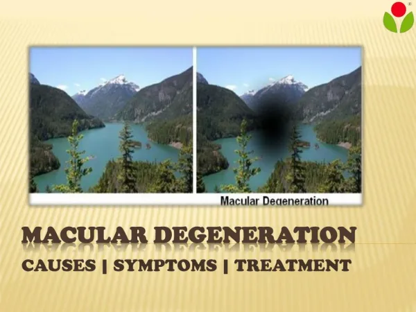 Macular Degeneration : causes, symptoms and treatment