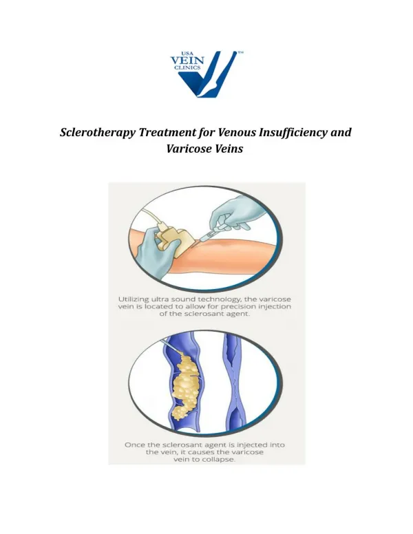 Sclerotherapy Treatment for Venous Insufficiency and Varicose Veins