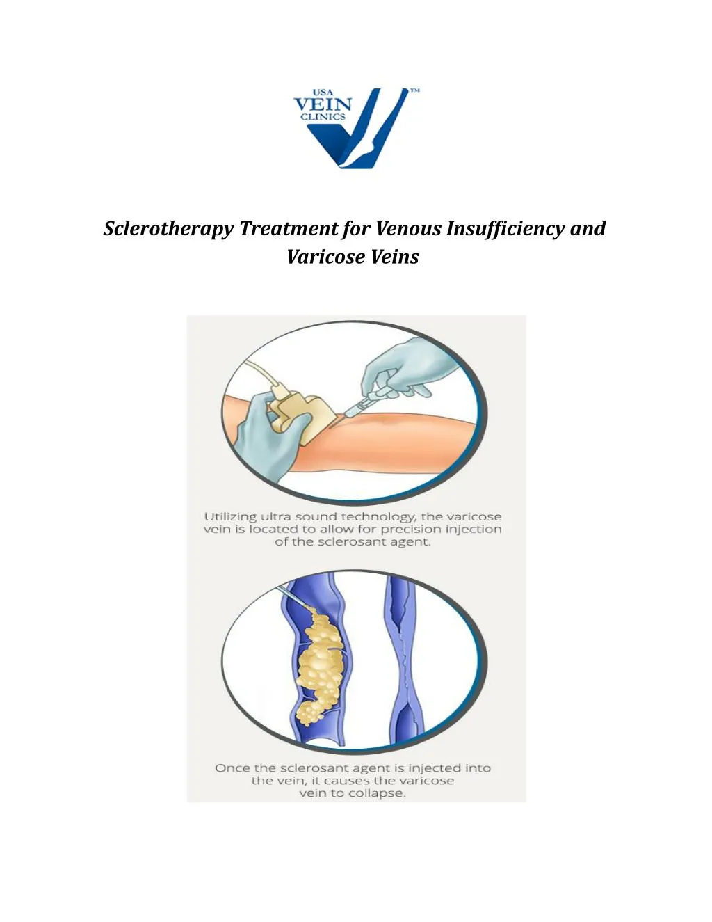 sclerotherapy treatment for venous insufficiency