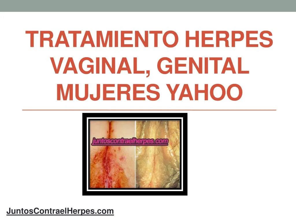 tratamiento herpes vaginal genital mujeres yahoo