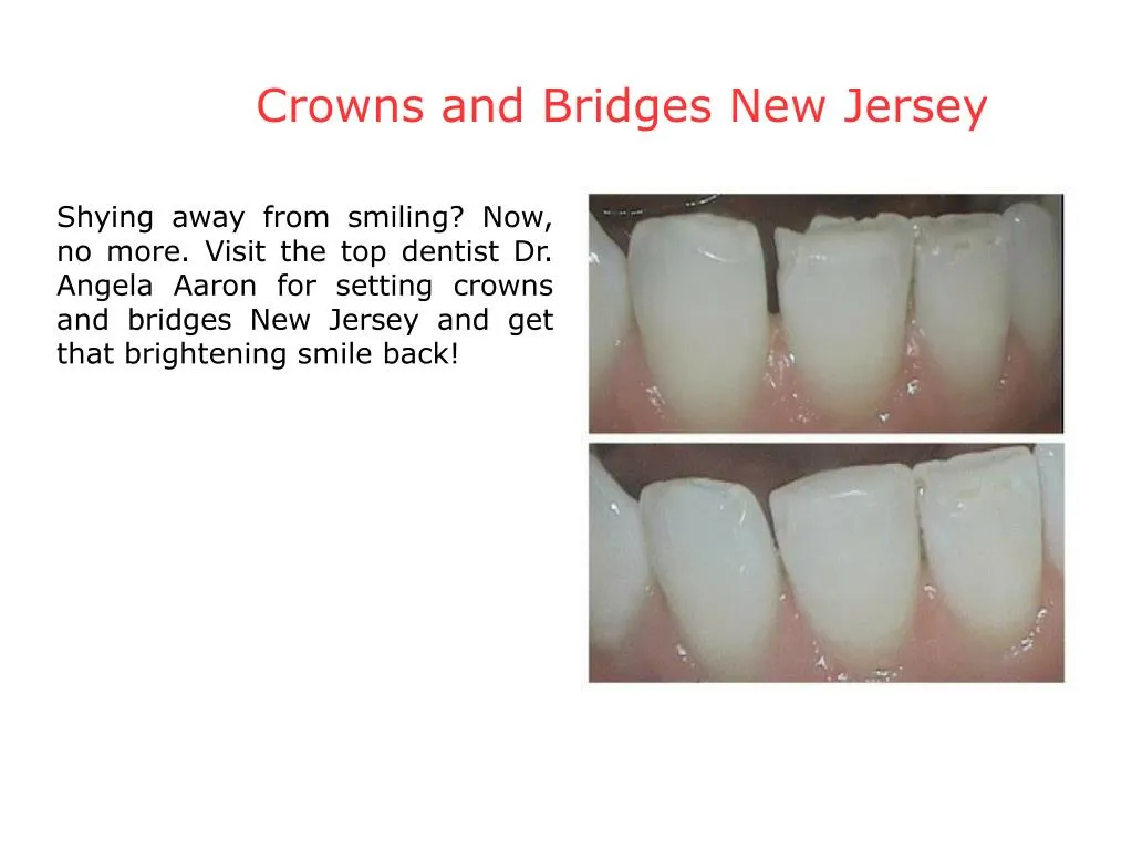 crowns and bridges new jersey