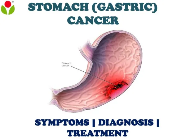 Stomach (Gastric) Cancer: Overview of symptoms, diagnosis and treatment