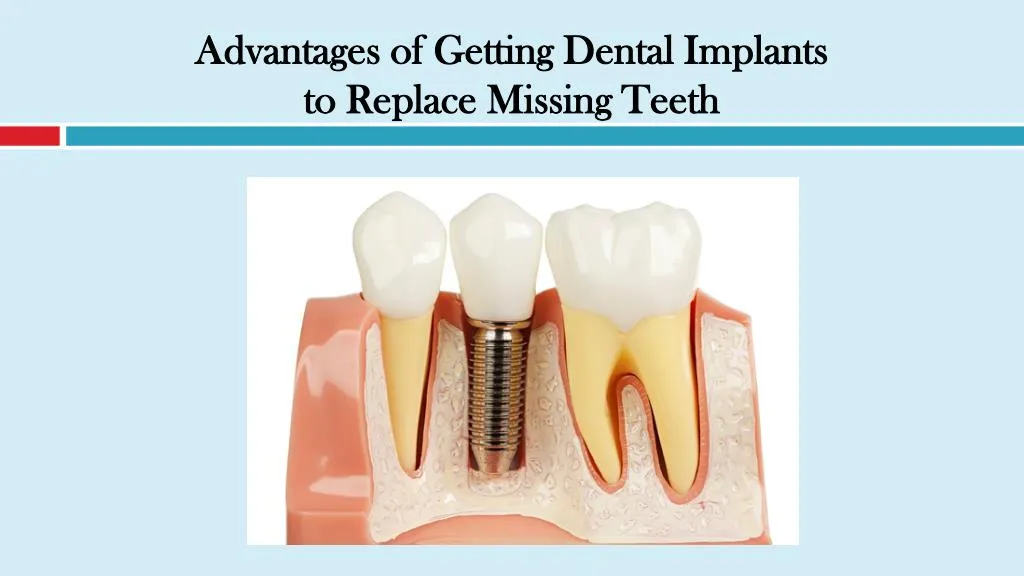 advantages of getting dental implants to replace missing teeth