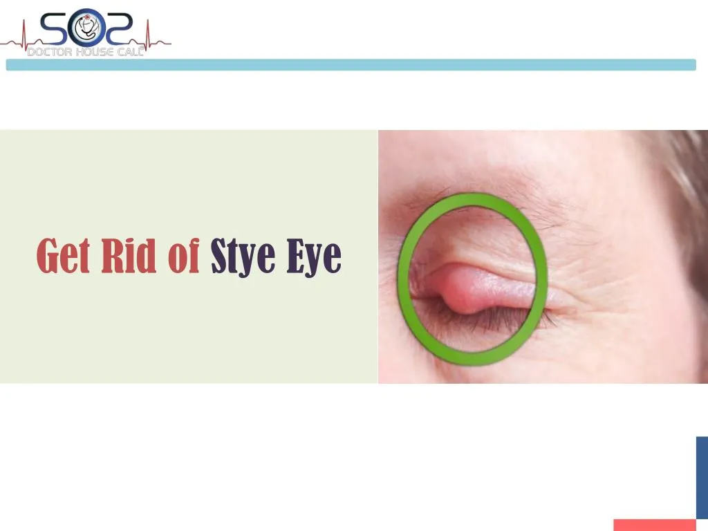 get rid of stye eye