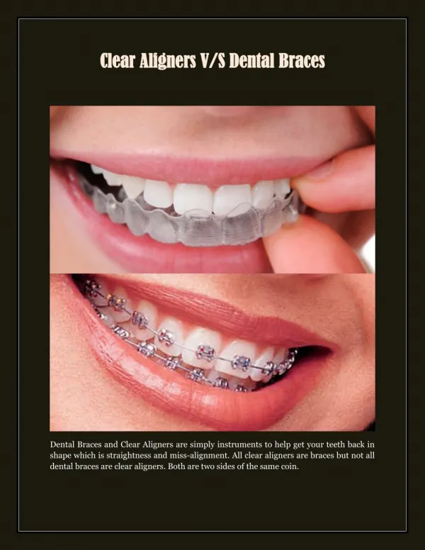 Clear Aligners V/S Dental Braces
