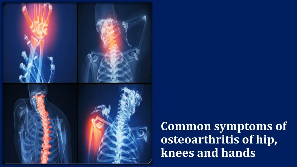 common symptoms of osteoarthritis of hip knees and hands