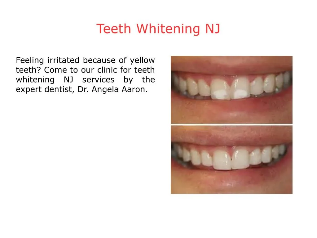 teeth whitening nj