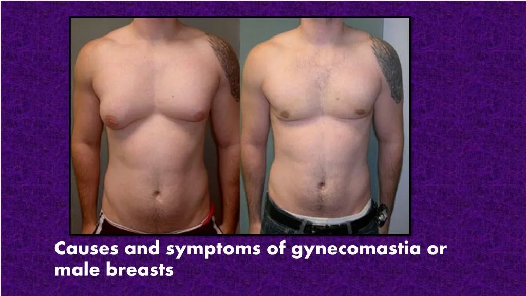 causes and symptoms of gynecomastia or male breasts