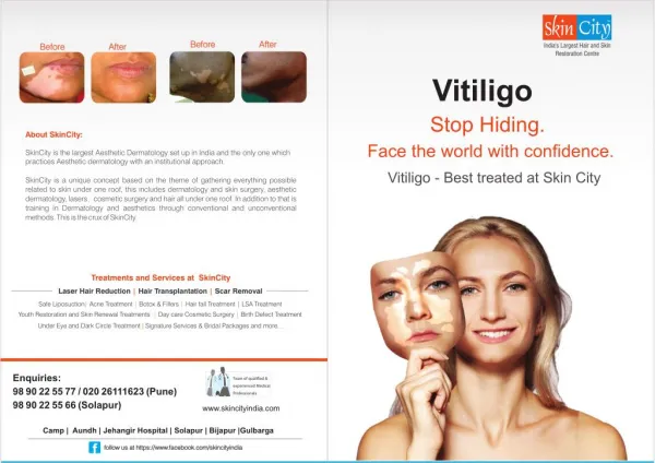 Vitiligo Treatments - Stop Hiding Face the world with Confidence