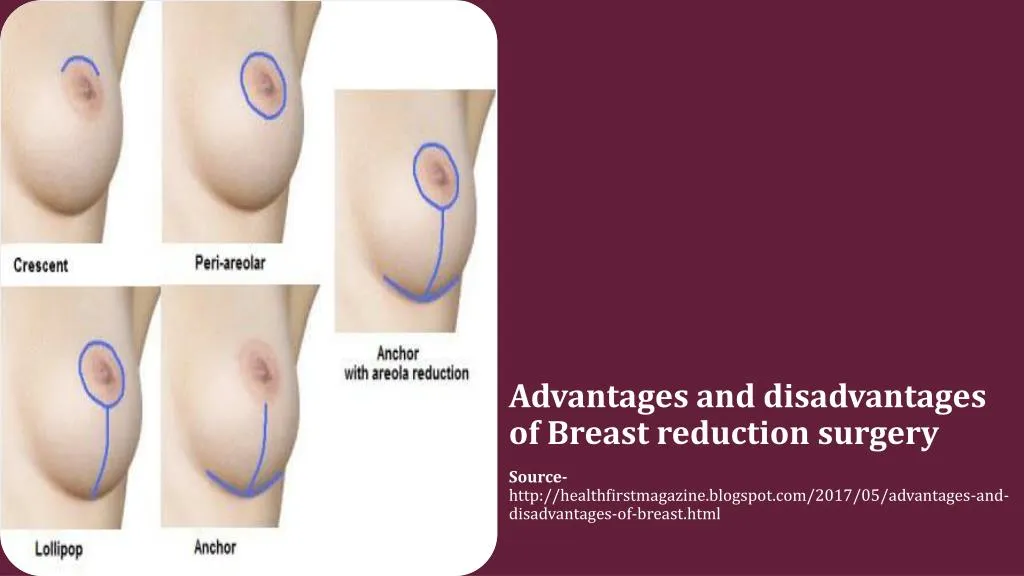 advantages and disadvantages of breast reduction surgery